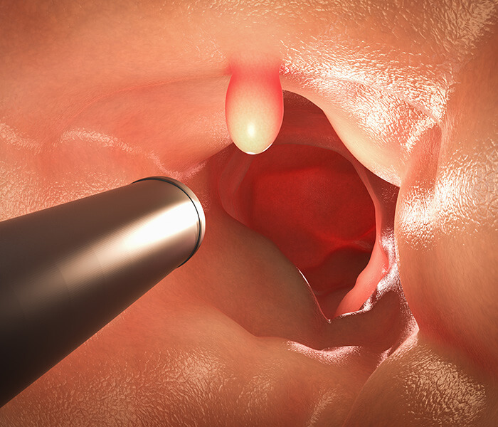 大腸ポリープの日帰り手術