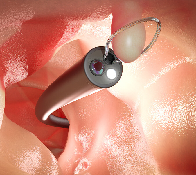 日帰り大腸ポリープ切除